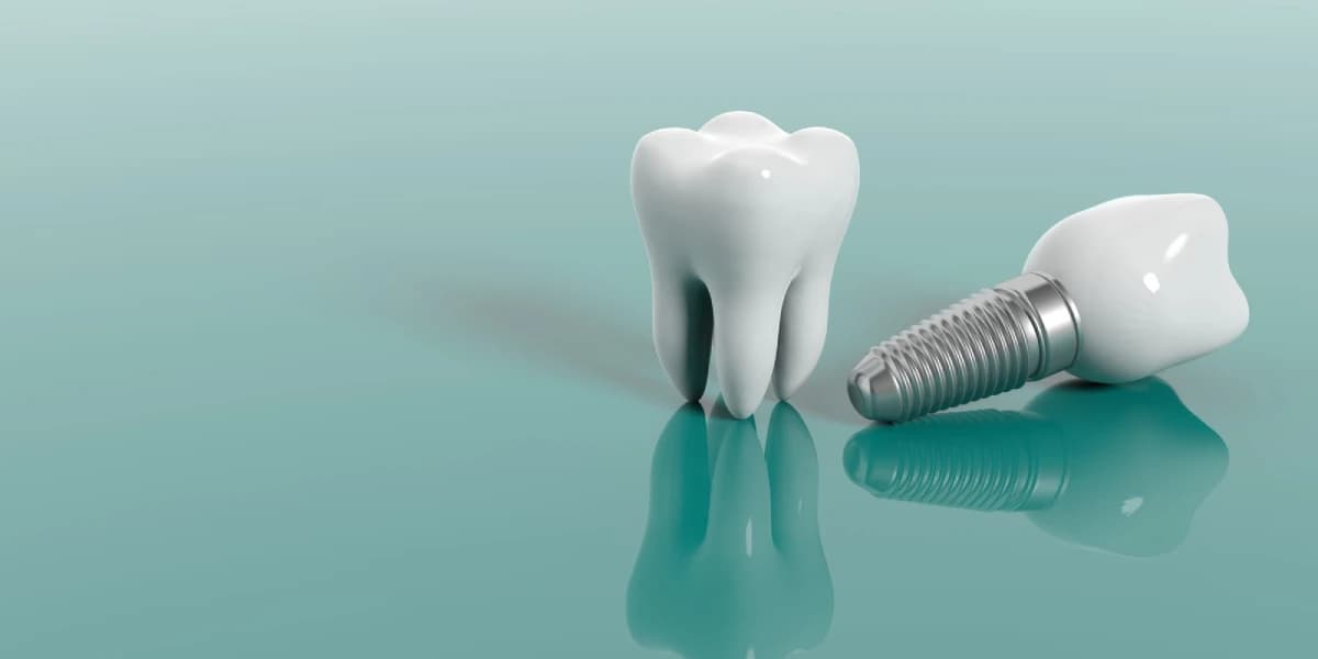Dental implants service hero image